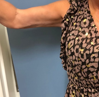 Arm Lift Before & After Patient #4047