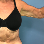 Arm Lift Before & After Patient #4047