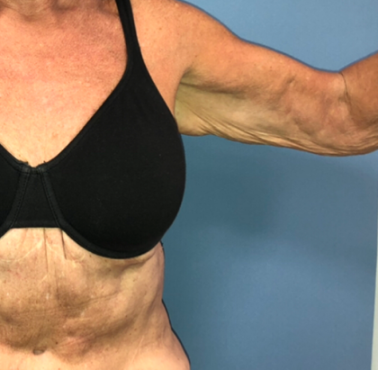 Arm Lift Before & After Patient #4047