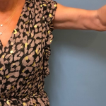 Arm Lift Before & After Patient #4047