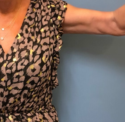 Arm Lift Before & After Patient #4047