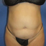 Liposuction and VASERLipo Before & After Patient #4115