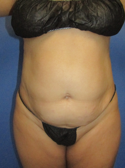 Liposuction and VASERLipo Before & After Patient #4115