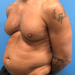 Liposuction and VASERLipo Before & After Patient #4079