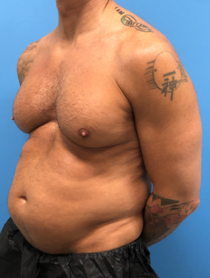 Liposuction and VASERLipo Before & After Patient #4079
