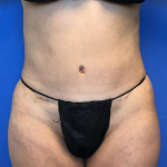 Liposuction and VASERLipo Before & After Patient #4115