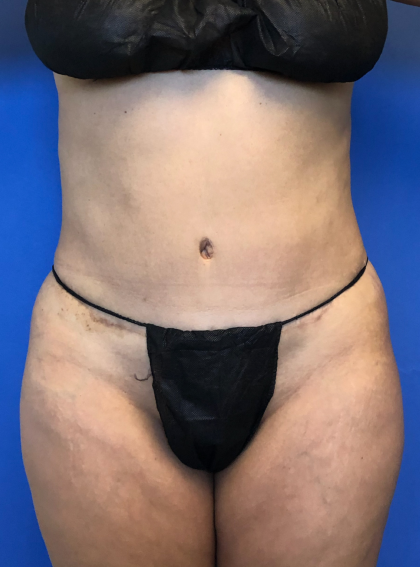 Liposuction and VASERLipo Before & After Patient #4115