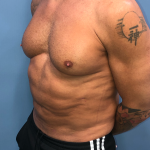Liposuction and VASERLipo Before & After Patient #4079