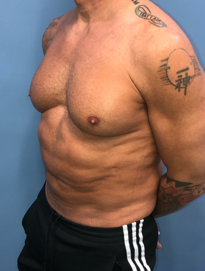 Liposuction and VASERLipo Before & After Patient #4079