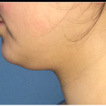 Necklipo Before & After Patient #4070