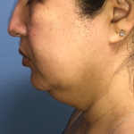 Necklipo Before & After Patient #4071