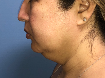Necklipo Before & After Patient #4071