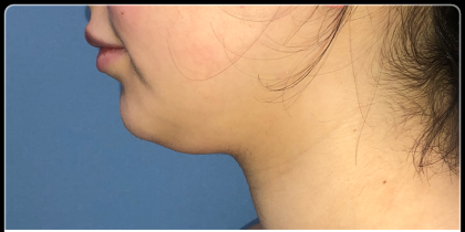 Necklipo Before & After Patient #4070