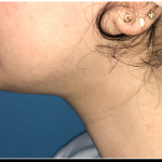 Necklipo Before & After Patient #4070