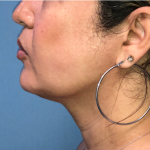 Necklipo Before & After Patient #4071