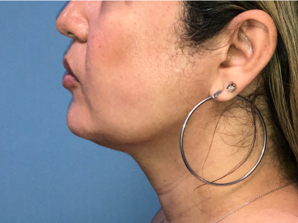 Necklipo Before & After Patient #4071
