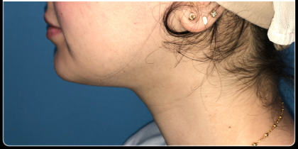 Necklipo Before & After Patient #4070