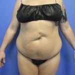 Liposuction and VASERLipo Before & After Patient #4099