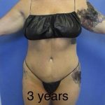 Liposuction and VASERLipo Before & After Patient #4099