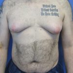 Male Breast Reduction Before & After Patient #4162