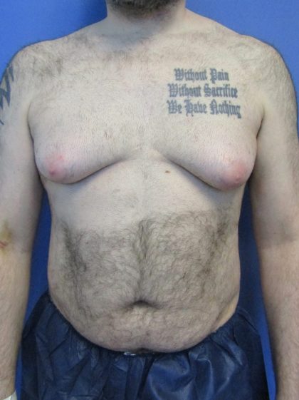 Male Breast Reduction Before & After Patient #4162