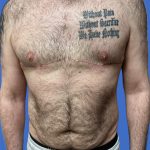 Male Breast Reduction Before & After Patient #4162