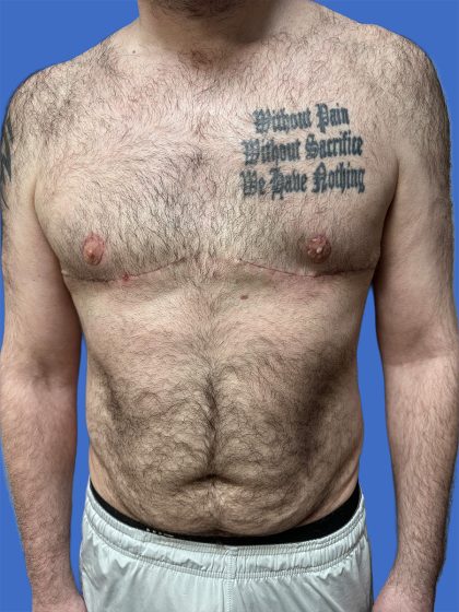 Male Breast Reduction Before & After Patient #4162