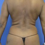 Liposuction and VASERLipo Before & After Patient #4169