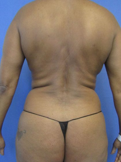 Liposuction and VASERLipo Before & After Patient #4169