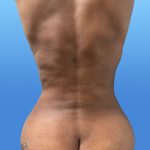 Liposuction and VASERLipo Before & After Patient #4169