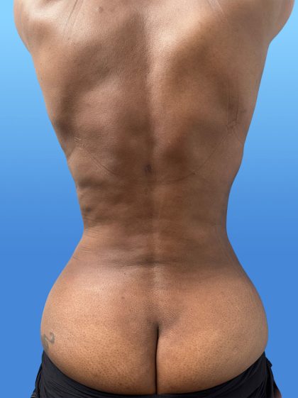 Liposuction and VASERLipo Before & After Patient #4169