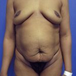 Tummy Tuck Before & After Patient #4173