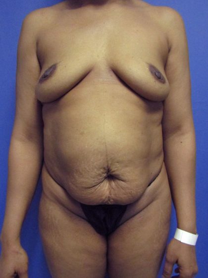 Mommy Makeover Before & After Patient #4172
