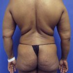 Liposuction and VASERLipo Before & After Patient #4170