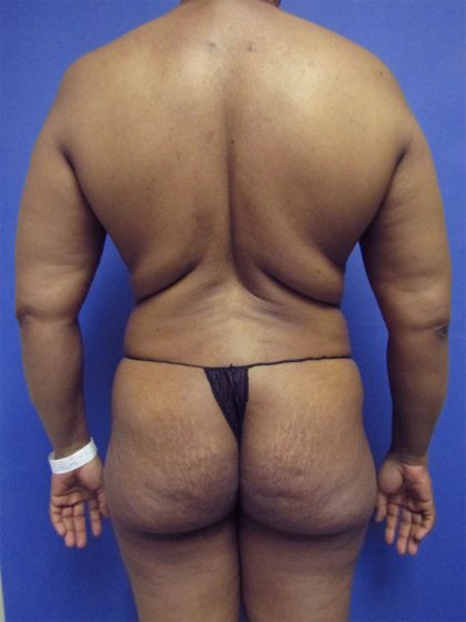 Brazilian Butt Lift Before & After Patient #4171