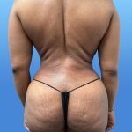 Liposuction and VASERLipo Before & After Patient #4170