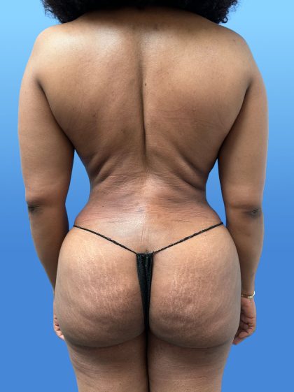 Brazilian Butt Lift Before & After Patient #4171