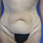 Tummy Tuck Before & After Patient #4160