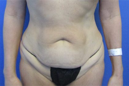 Tummy Tuck Before & After Patient #4160