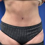 Tummy Tuck Before & After Patient #4160