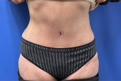 Tummy Tuck Before & After Patient #4160