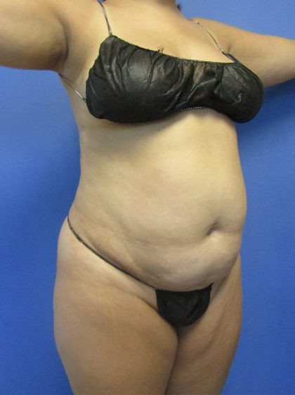 Tummy Tuck Before & After Patient #4161
